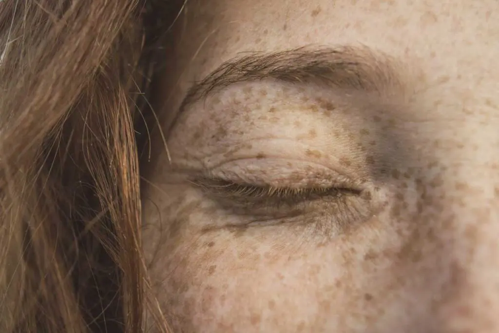 Melanoma