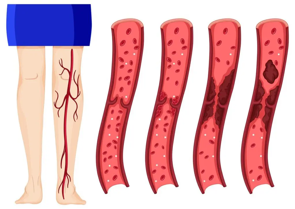 “Uno escucha la palabra trombosis y piensa en lo peor”