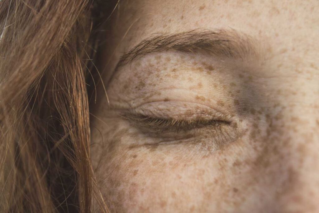Melanoma